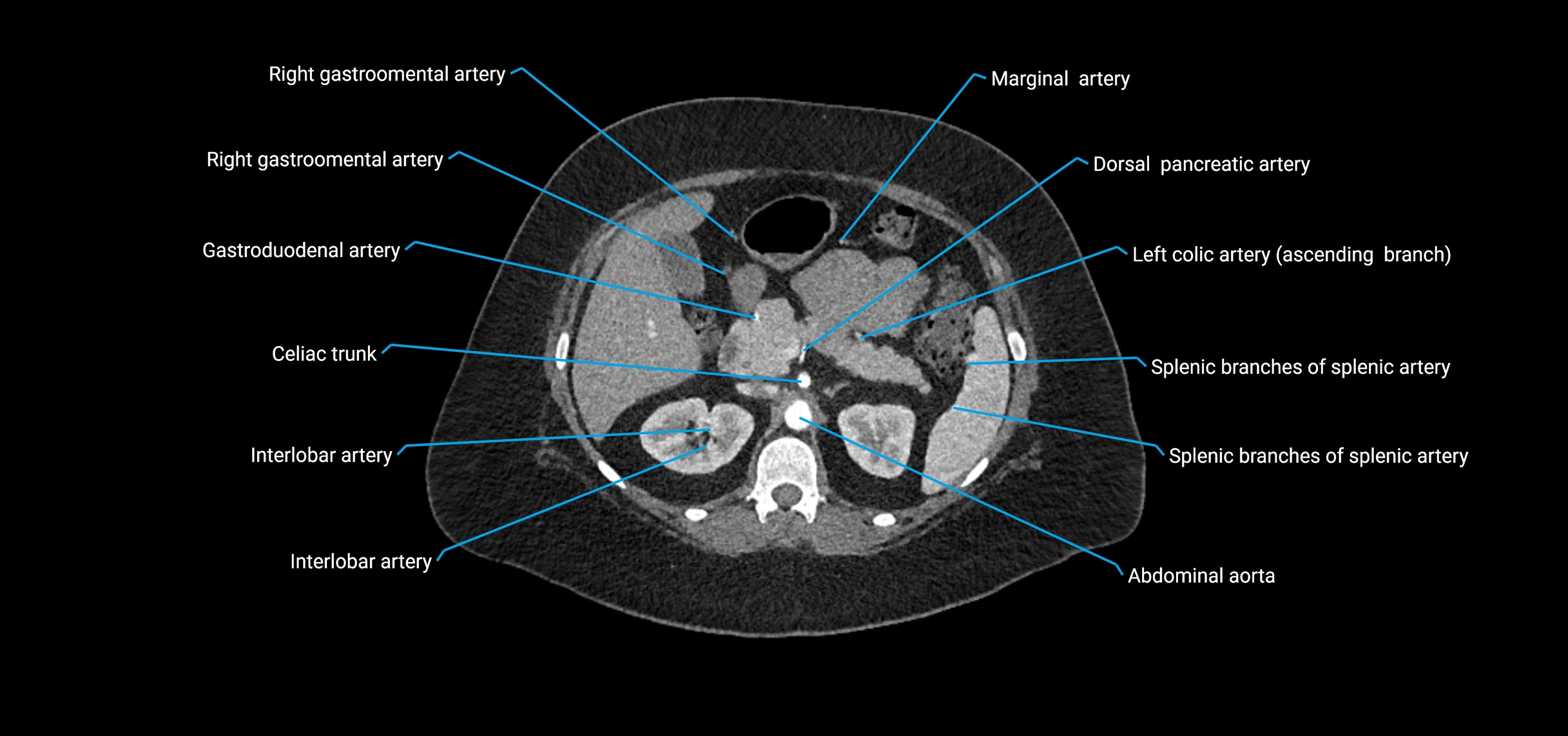 CTA abdomen axial cross sectional anatomy labelled image_59 (2).webp